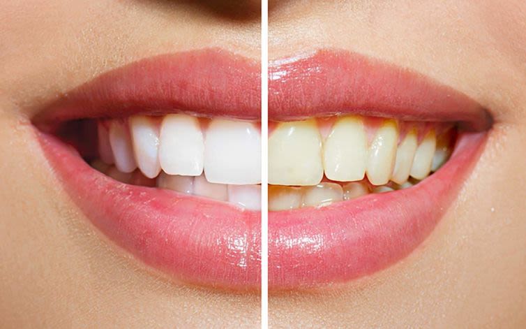 A satisfied patient with a radiant, white smile, symbolizing the confidence boost from effective teeth whitening Dundee