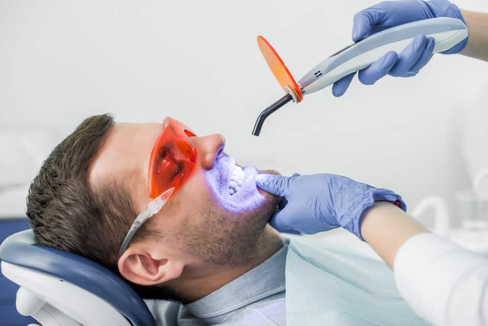 Why Laser Teeth Whitening is the Top Choice for Smokers Dundee