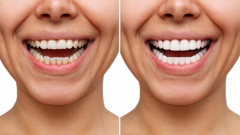 Contact Aspire White for teeth whitening services – Get in touch with Dundee today