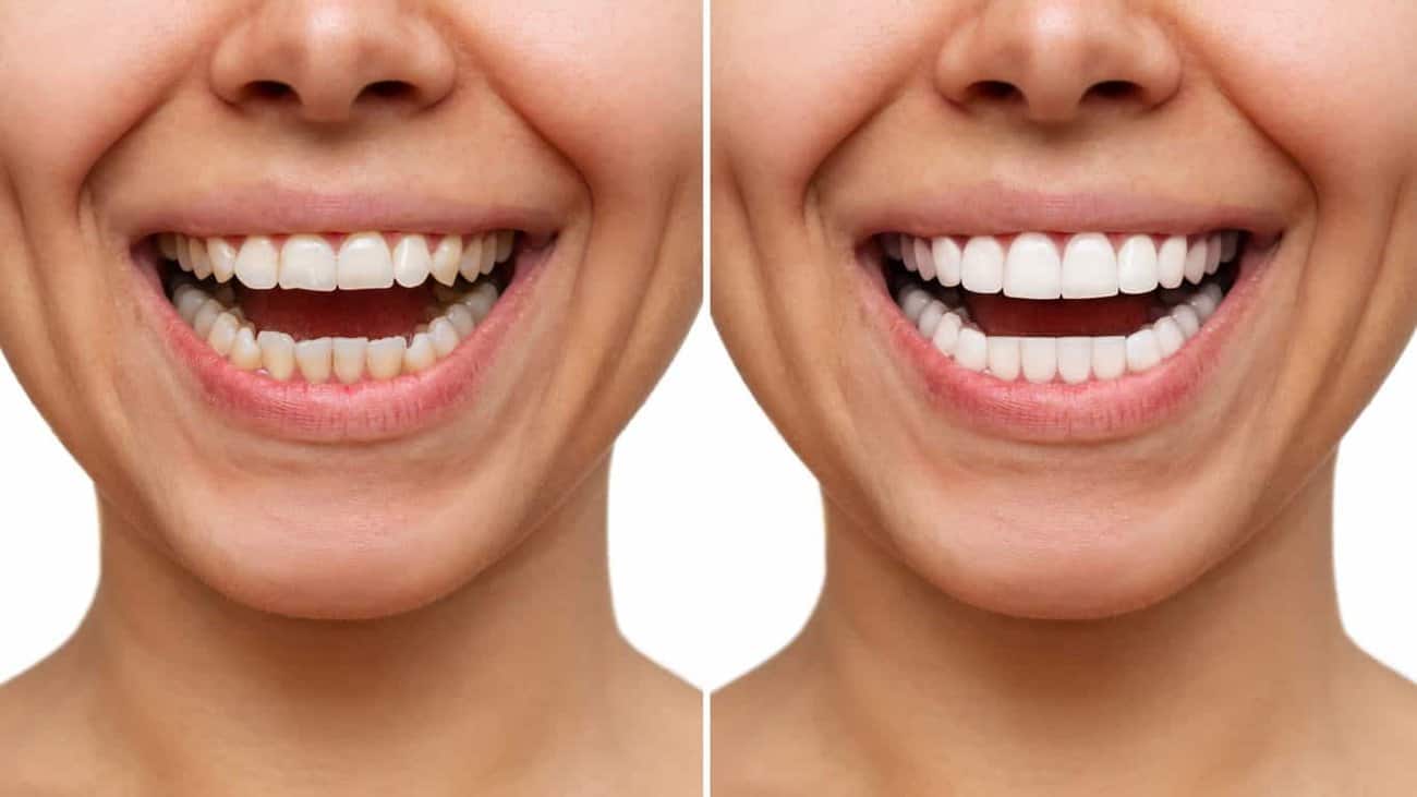 Contact Aspire White for teeth whitening services – Get in touch with Dundee today