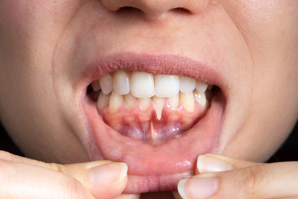Preparing for teeth whitening with receding gums Dundee