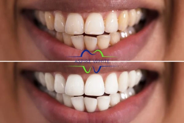 Aspire White customer before and after Dundee results.