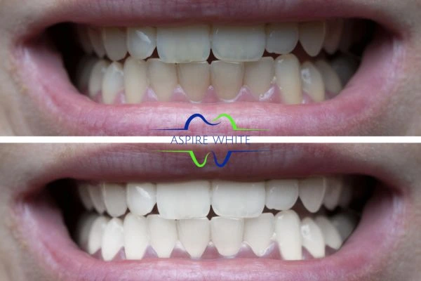 1 hour laser teeth whitening before and after results Dundee