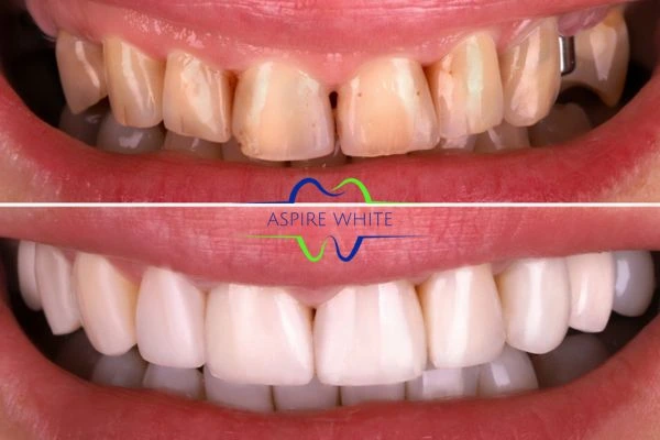 Yellow teeth results - 1 hour whitening before and after results Dundee
