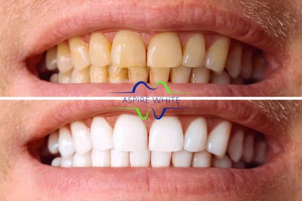 Get noticeable whiter smile in just one hour! Book your teeth whitening treatment Dundee today!