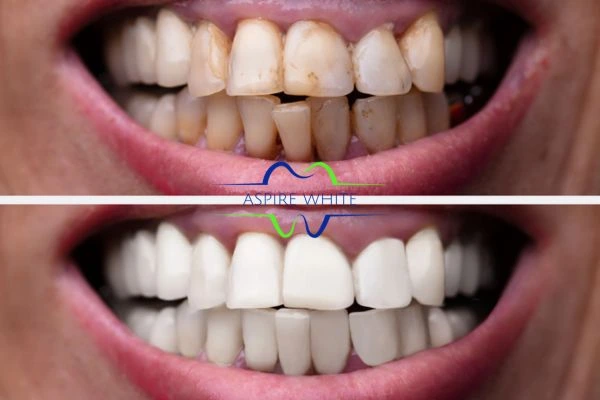 Before and after results of laser teeth whitening Dundee Book in online today!