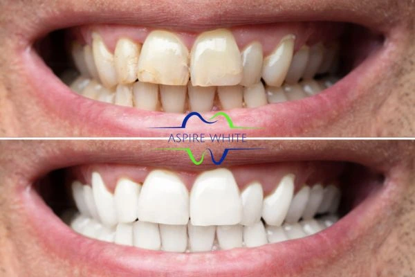 Achieve a radiant smile with professional laser teeth whitening Dundee